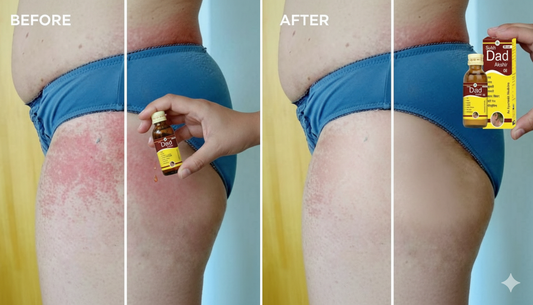 Anti-Fungal Oil for Thigh & Groin Area