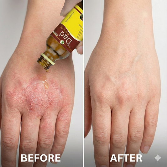 Ayurvedic Oil for Psoriasis & Chronic Itchy Skin Support