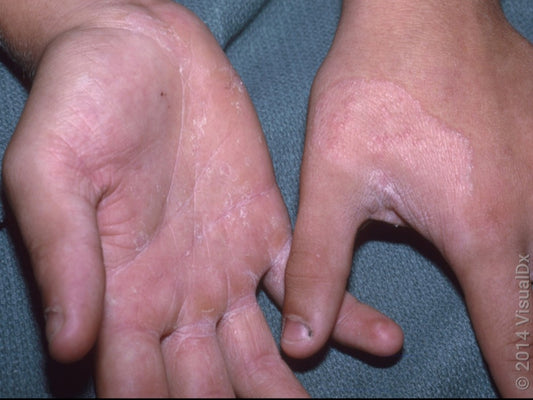 Anti-Fungal Oil for Hand & Leg Infection